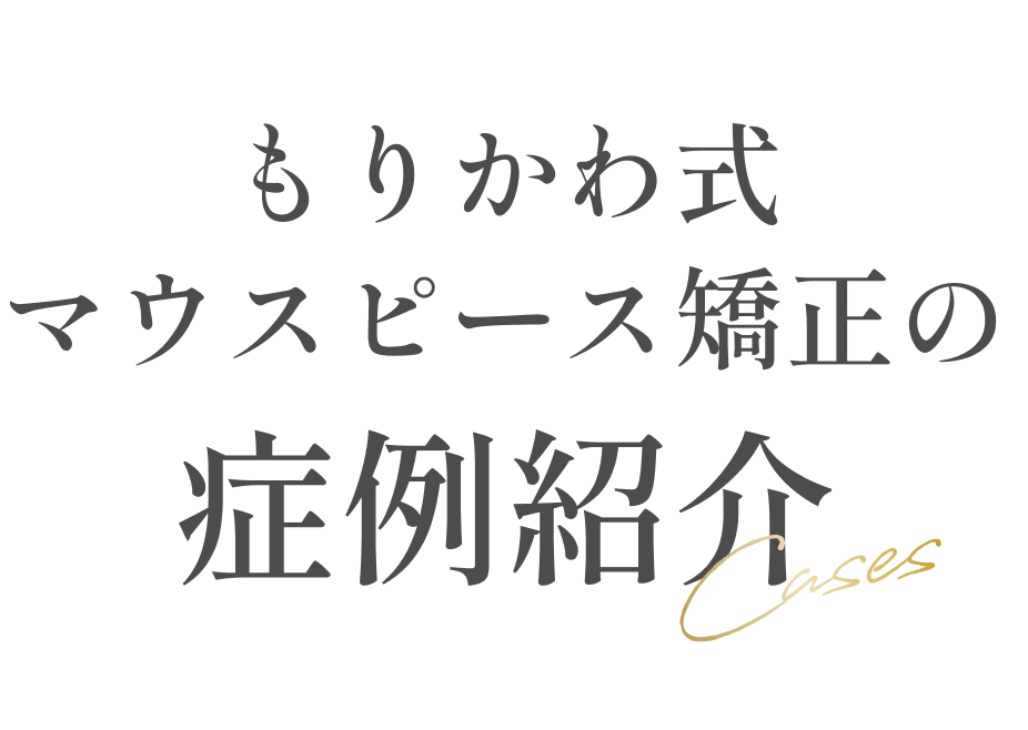 もりかわ式マウスピース矯正の症例紹介